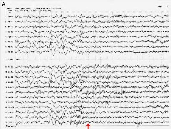Κρίση βρεγματικού λοβού αριστερά Έναρξη (βέλος) με ταχεία παροξυσμική