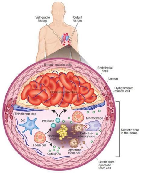 Неколико истраживања интраваскуларним ултразвуком (IVUS) указало је на различите предикторе no-reflow феномена у акутном коронарном синдрому.