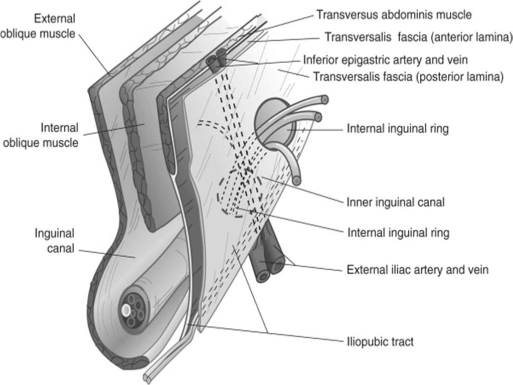 Ανατομία Λαγονοκτενιαία ταινία (iliopubic tract) Ουσιαστικά επενδύει το κάτω έσω ήμισυ του βουβωνικού συνδέσμου (συγχέεται) Αποτελεί το