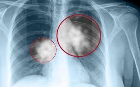 Δ. ΚΑΡΚΙΝΟΣ ΤΟΥ ΠΝΕΥΜΟΝΑ Τα καρκινώματα του πνεύμονα εξορμώνται από το επιθήλιο των βρόγχων συνήθως γύρω στην
