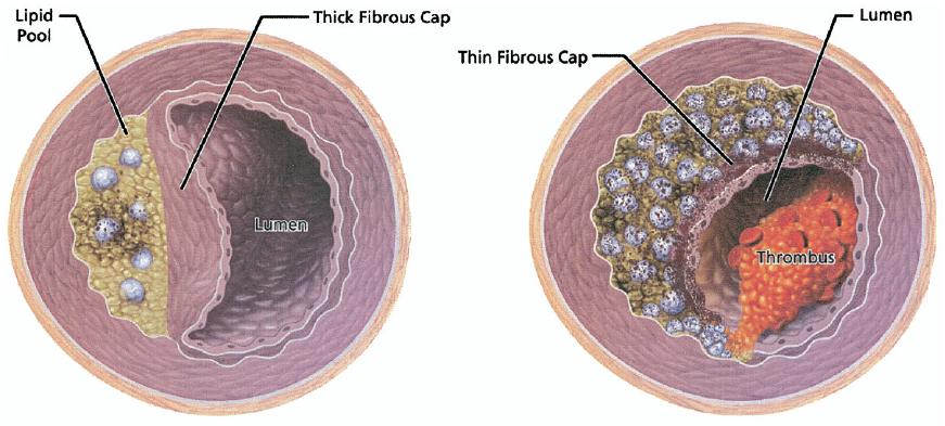 Contrasting histopathologic characteristics of a stable versus ruptured plaque.