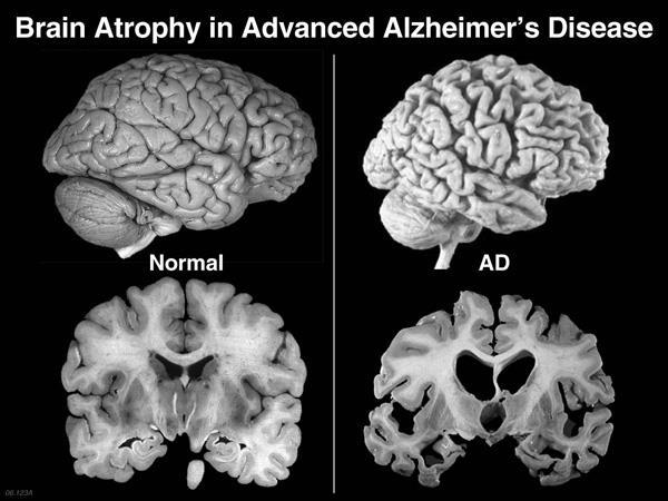 22 Εικόνα 4: Στην αριστερή εικόνα παρατηρούμε έναν φυσιολογικό εγκέφαλο, ενώ στη δεξιά φαίνεται ο εγκέφαλος ασθενούς που πάσχει από «Alzheimer».