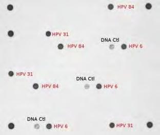 84, 85 και 89 του HPV. Οι έντονες κουκίδες αποτελούν την επιβεβαίωση της ύπαρξης γενωμικού DNA στο υπό εξέταση δείγμα η οποία προκύπτει από την ενίσχυση τμήματος του ανθρώπινου γονιδίου CFTR.