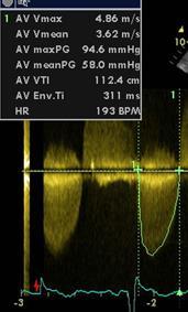 βαλβίδας (cm 2 ) 40 <1 (<0,6 cm 2