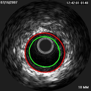 Σε αυτή την παράγραφο παρουσιάζονται ορισμένα αποτελέσματα εικόνων IVUS που παρήχθησαν με τη χρήση του καθετήρα Volcano Theurapeutics, συχνότητας εκπομπής υπερήχων 45MHz.