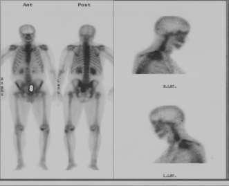 12/2016: Σπινθηρογράφημα οστών με γ-κάμερα Αυξημένη καθήλωση του ραδιοφαρμάκου στους Θ3-Θ4,Ο1 και στο ιερό οστό.