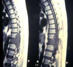 Μεταστατική νόσος & ΣΣΝΜ -Διάγνωση - Ο έλεγχος με MRI ολόκληρης της ΣΣ είναι η αρχική εξέταση εκλογής, με