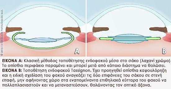 αποκατάστασης. Ο ιατρός θα σας ζητήσει να κάνετε τακτικές επισκέψεις στο ιατρείο για να παρακολουθεί την κατάσταση του φακού μέσα στο μάτι σας. 8.