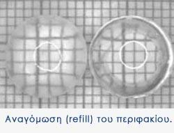 Αναγόμωση του περιφακίου (Lens refilling).