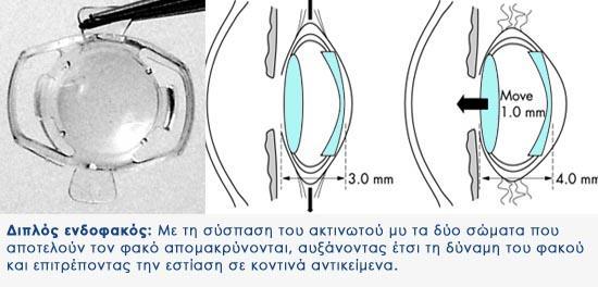 φακό. Η μέθοδος αυτή φιλοδοξεί να χρησιμοποιήσει το φυσικό σύστημα εστίασης που διαθέτει το ανθρώπινο μάτι, αλλά βρίσκεται ακόμα μακριά από