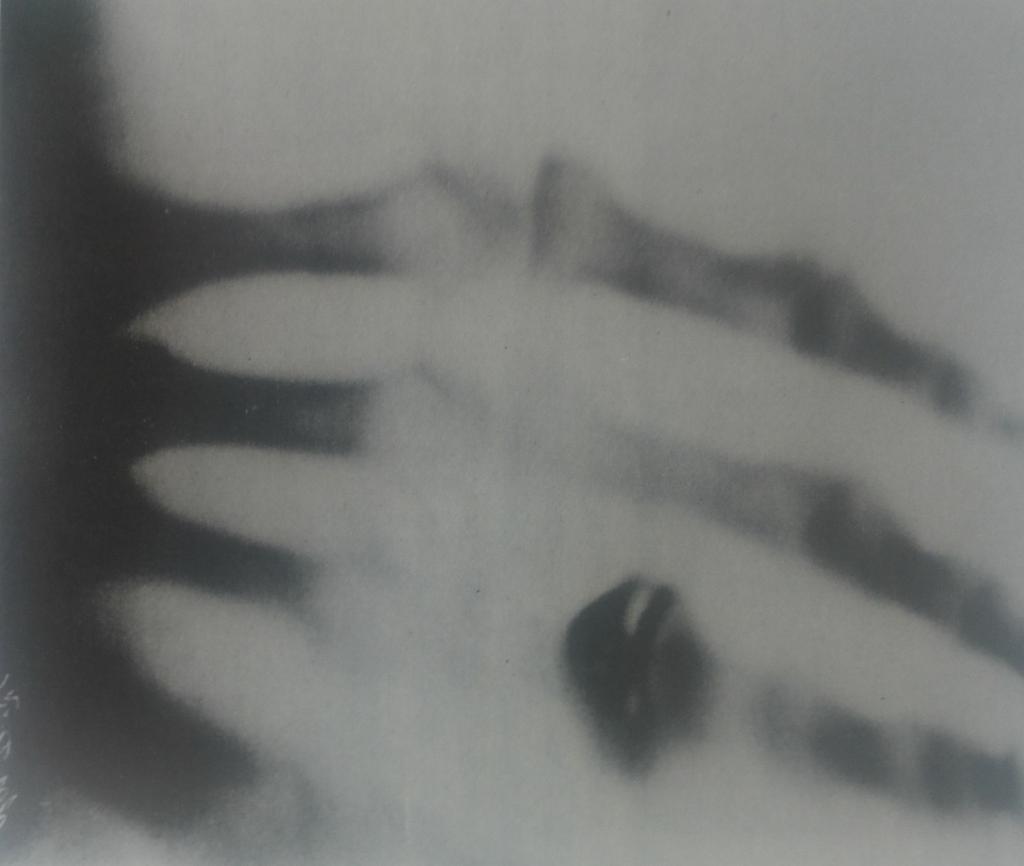 Η πρώτη ακτινογραφία μέλους ανθρώπινου σώματος. Είναι το χέρι της κυρίας Roentgen.