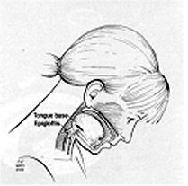Σύμφωνα με την κατάταξη της Logemann (1987), οι τεχνικές στάσης περιλαμβάνουν αλλαγές στη στάση του σώματος και της κεφαλής (postural techniques), όπως: Α) Κάμψη της κεφαλής προς τα εμπρός (chin