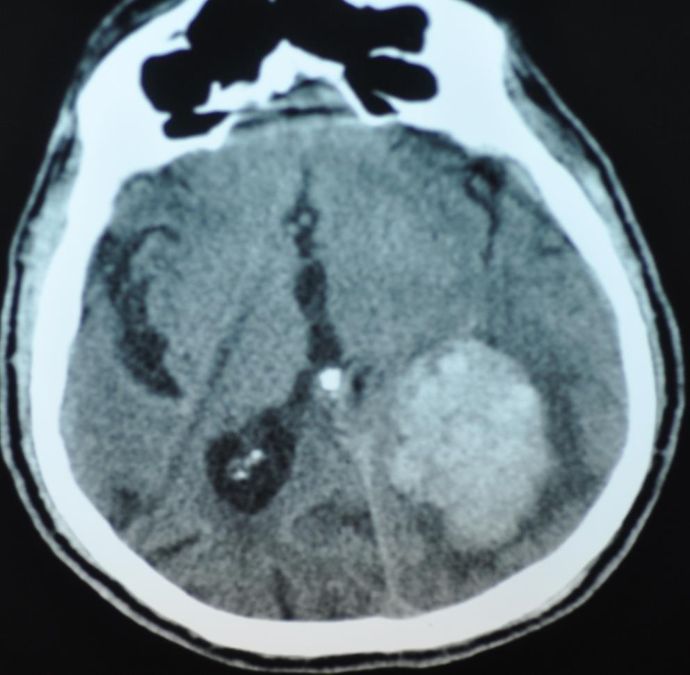Case-1 Stroke severity should be based on imaging and