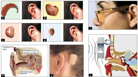 Εικόνα 3. Τύποι ακουστικών βαρηκοΐας. Στην παραπάνω εικόνα, φαίνονται αναλυτικά οι τύποι των ακουστικών που κυκλοφορούν αυτή τη στιγμή στην αγορά (Θ. Π. Νικολόπουλος, Ν.Δ.