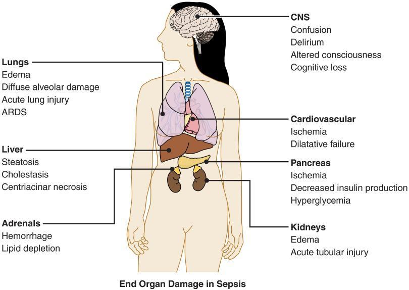 Εικόνα 1. Σχηματική απεικόνιση του όρου σήψη Σοβαρή Σήψη (severe sepsis) ορίζεται η σήψη, που συνοδεύεται από δυσλειτουργία οργάνων, αρτηριακή υπόταση ή ιστική υποάρδευση.