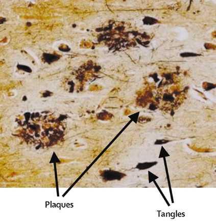 (dystrophic neuritis), ενεργοποιημένα αστροκύτταρα (reactive astrocytes) και μικρογλοία (microglia), ενώ τα δεμάτια είναι ενδοκυτταρικά συσσωματώματα (intracellular aggregates) που αποτελούνται από