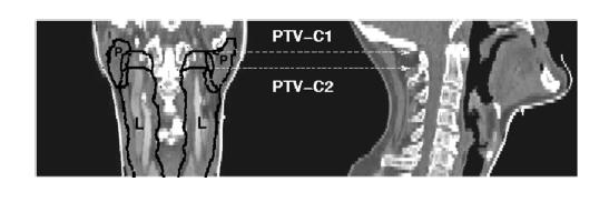 Σχήα 17: Μετωπιαία και οβελιαία άποψη του κρανιακού συνόρου του υπό στόχευση όγκου σχεδιασού (PTV) των λεφαδένων επιπέδου II που οριοθετείται έχρι την εγκάρσια τοή του άτλαντα C1 (του πρώτου