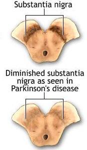 Νόσος του Parkinson (Παθοφυσιολογία)