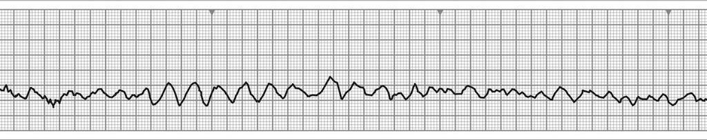 Figura 52: Fibrilaţie ventriculară cu unde mari Figura 53: Fibrilaţie ventriculară cu unde mici TAHICARDIA VENTRICULARĂ Este expresia unor depolarizări succesive de origine ventriculară (sub