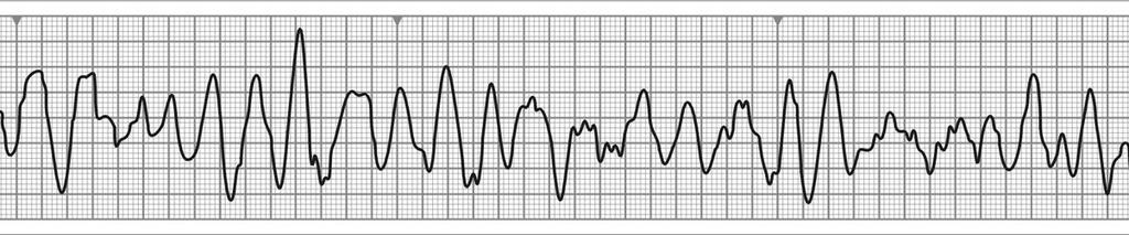 şi care se însoţeşte de colaps hemodinamic (fig.54). ECG-ul redă un traseu pe care se evidenţiază complexe QRS largi (>0,12sec.
