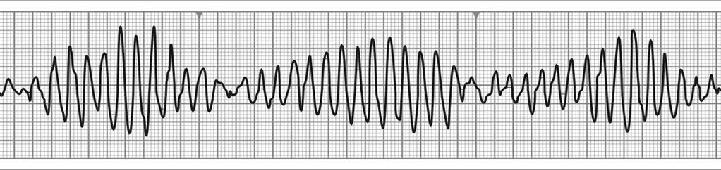 Electrocardiografic asistola este reprezentată de o linie