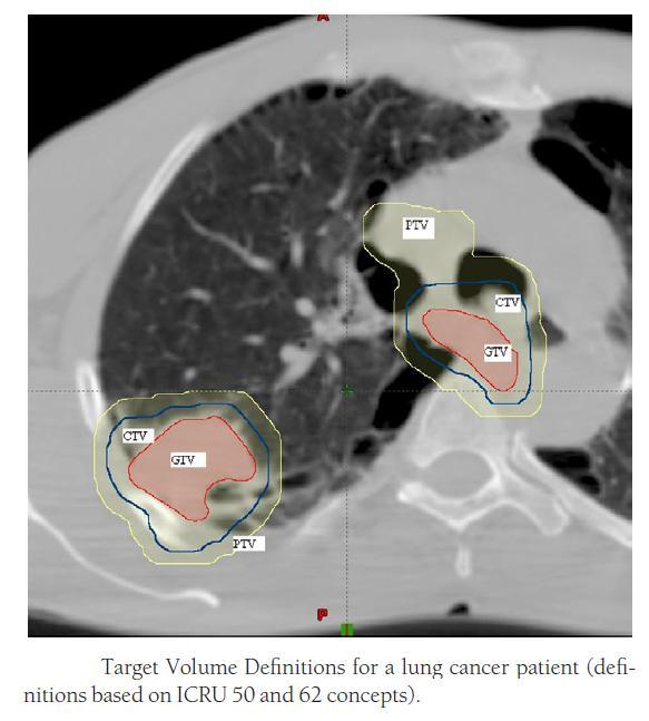 Kαθοπιζμόρ ζηόσος και κπίζιμων οπγάνων Gross tumor volume (GTV): νξαηή καθξνζθνπηθή λόζνο