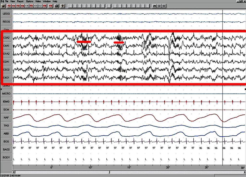 θπκαηίδηα, ζπρλφηεηαο απφ 11 σο 16 Hz πεξίπνπ, πνπ έρνπλ πνιχ ραξαθηεξηζηηθή κνξθνινγία, ζηαδηαθά απμαλφκελνπ θαη κεηά κεηνχκελνπ πιάηνπο, κνηάδνπλ κε ην αδξάρηη (άηξαθηνο) ηνπ αξγαιεηνχ θαη ην