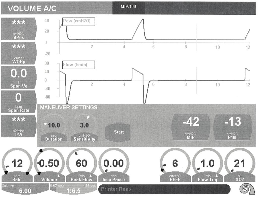 Συστήματα αερισμού AVEA 117 Οθόνη χειρισμού MIP / P 100 Σχήμα 4-12: Ρυθμίσεις χειρισμού MIP Ο χειρισμός MIP (Μέγιστη εισπνευστική πίεση) / P100 μετρά την αρνητική απόκλιση στο ίχνος πίεσης κατά τη