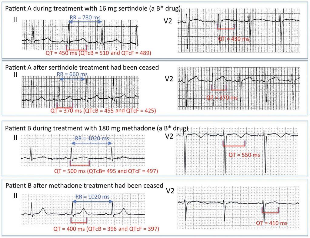 Two cases of drug-induced QT prolongation. Søren Fanoe et al.