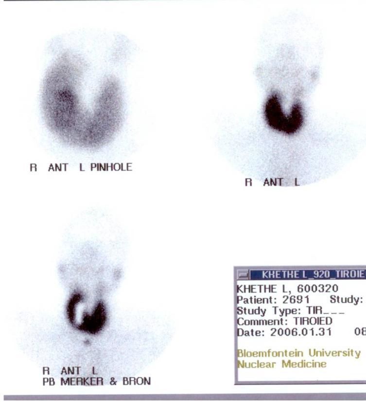 GRAVE S PATIENT S WORKOUT BEFORE RAI TREATMENT FIRST: RA I-131 UPTAKE THEN: TECHNESIUM