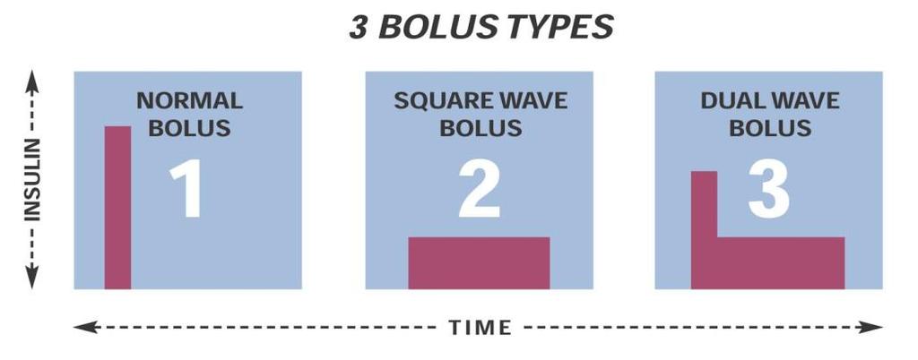 Τύποι Bolus Οι δόσεις Bolus μπορούν να χορηγηθούν με τρεις διαφορετικούς τρόπους καλύπτοντας διαφορετικού τύπου γεύματα Normal-