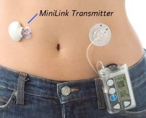 Technology (Smart insulin pump with Bolus Wizard