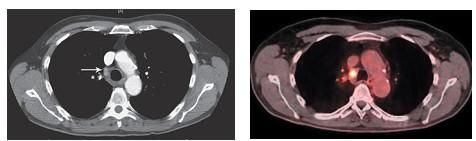 Illustration 5: PET θετικός λεμφαδένας Illustration 4: CT θετικός λεμφαδένας Illustration 6: Μεταβολή στον ορισμό του GTV κατά 70% λόγω αλλαγής window-level στο PET Κι ενώ το παραπάνω παράδειγμα