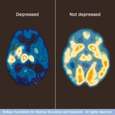 Τι συμβαίνει στην κατάθλιψη Η κατάθλιψη έχει κατά κάποια έννοια τοξική επίδραση στον εγκέφαλο. 2/3 των ασθενών έχουν αυξημένα επίπεδα στρεσογόνων ορμονών (π.χ. κορτιζόνη).