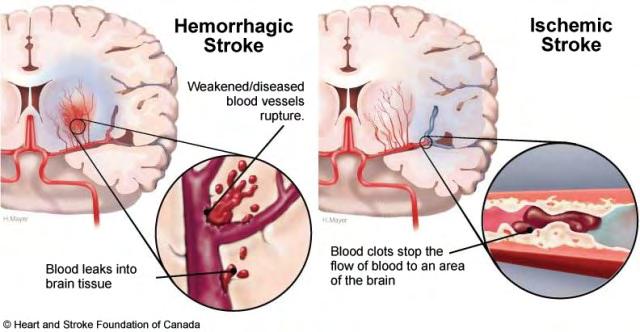 Αιμορραγικά: 15% των περιπτώσεων (αιμορραγικό εγκεφαλικό επεισόδιο ΑΕΕ).