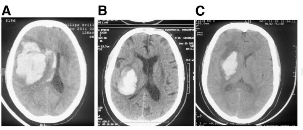 Εικόνα 24 Η παρουσία SIRS κατά τη στιγμή της εισαγωγής προβλέπει τη σοβαρότητα του εγκεφαλικού επεισοδίου και την έκβαση 3-μηνών. (A) 49 χρονών γυναίκα με αιμορραγία στο δεξί κέλυφος.