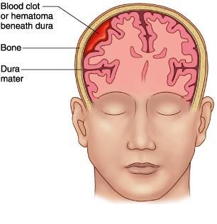 Eικ. 2 Χρόνιο υποσκληρίδιο αιμάτωμα, ( Πηγή: http://www.neurocenter.gr/afairesi-xroniou-yposkliridiouaimatomatos.