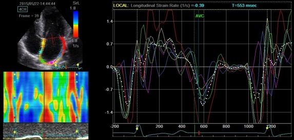 Μελέτη της µηχανικής του αριστερού κόλπου LA longitudinal Strain Rate as