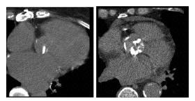 CT calcium scoring Ειδικά σε ασθενείς µε paradoxical low flow-low gradient ΑS, η εκτίµηση του φορτίου ασβεστίου µε αξονική τοµογραφία αποτελεί ασφαλή εναλλακτική για την εκτίµηση της