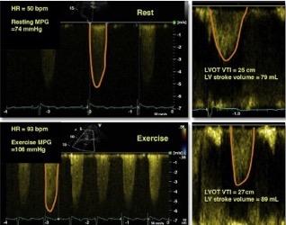 Ηχωκαρδιογραφία άσκησης σε ασθενείς µε σοβαρή ασυµπτωµατική AS ΙΙ 1. H αύξηση της µέσης διαβαλβιδικής κλίσης πίεσης πάνω από 18 mmhg υποθηκεύει την πρόγνωση. 2.