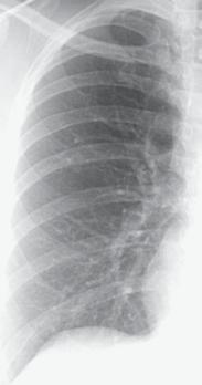 angle Left hemidiaphragm hemidiaphragm Costophrenic Costophrenic angle angle νως, το μέγεθος των αγγείων στη βάση είναι συνήθως μεγαλύτερο από το μέγεθος των αγγείων στην κορυφή των πνευμόνων.