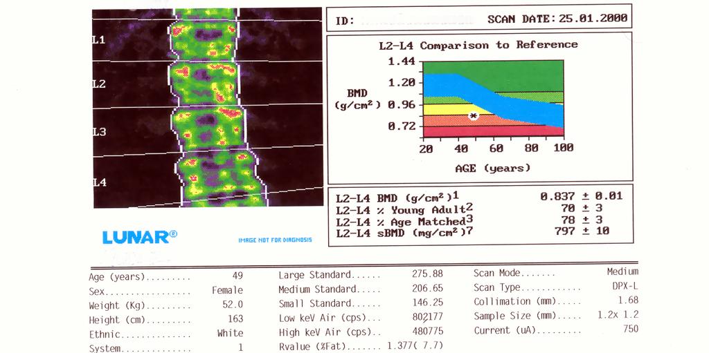 19 4.3.4. ΔΙΠΛΗ ΑΠΟΡΡΟΦΗΣΗ ΑΚΤΙΝΩΝ Χ (dual X-ray absorptiometry, DEXA) Στη μέθοδο αυτή αντί για πηγή ραδιενεργού ισοτόπου χρησιμοποιείται πάλι πηγή ακτίνων Χ.