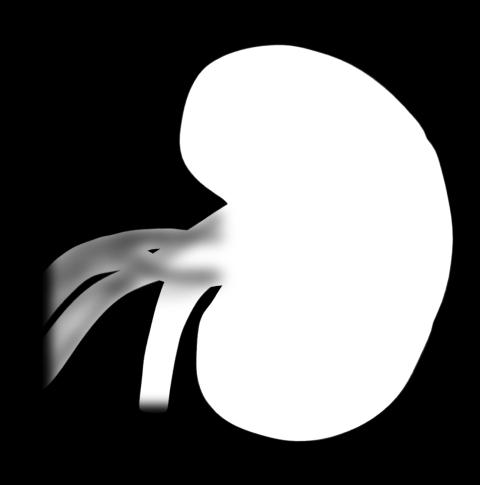 filtration SGLT, sodium-glucose co-transporter. 1.