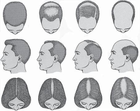 Alopecia 5 SEMNE DE GRAVITATE Virilizarea la femei. Semne de boli sistemice sau o constelaţie de manifestări care indică o posibilă intoxicaţie. tipică pattern-ului de alopecie masculină.