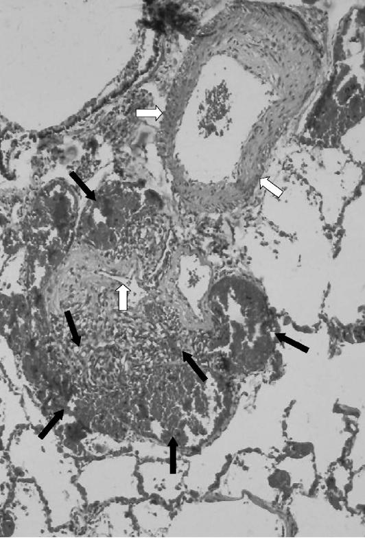 Πλεγματοειδείς βλάβες (Plexiform lesions) Smooth