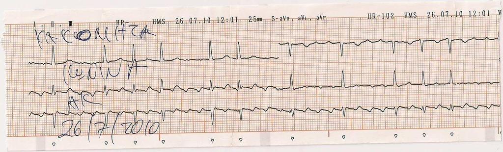 ECG