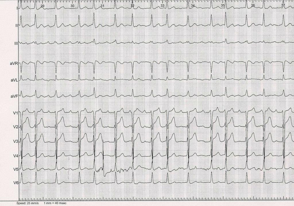 12-Lead 12-lead ECG A 68-year-old man with previous Circumferential Pulmonary Vein Ablation