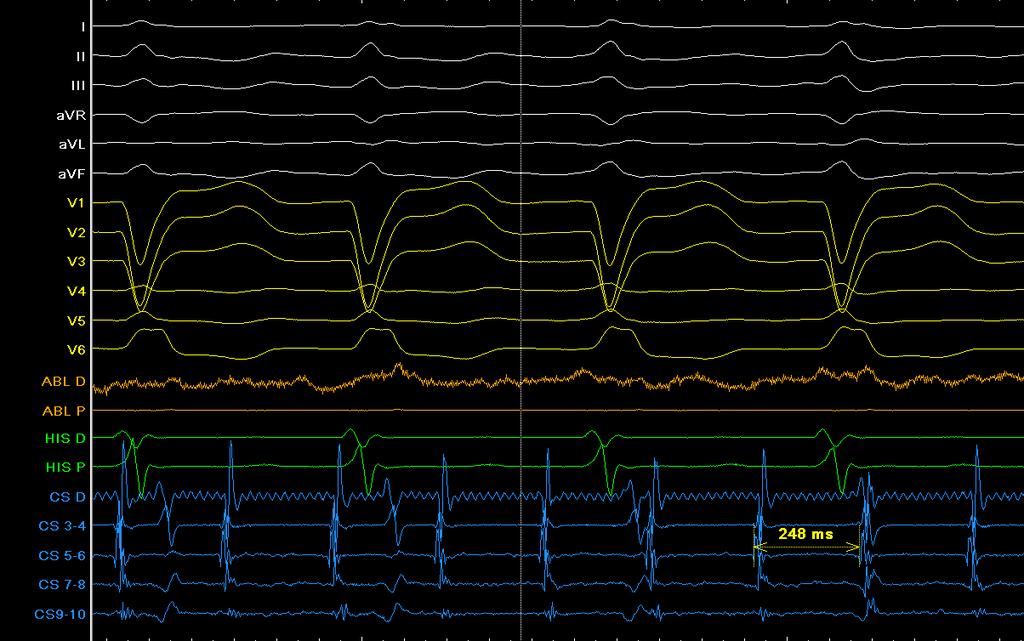 Organization to a stabile tachycardia after