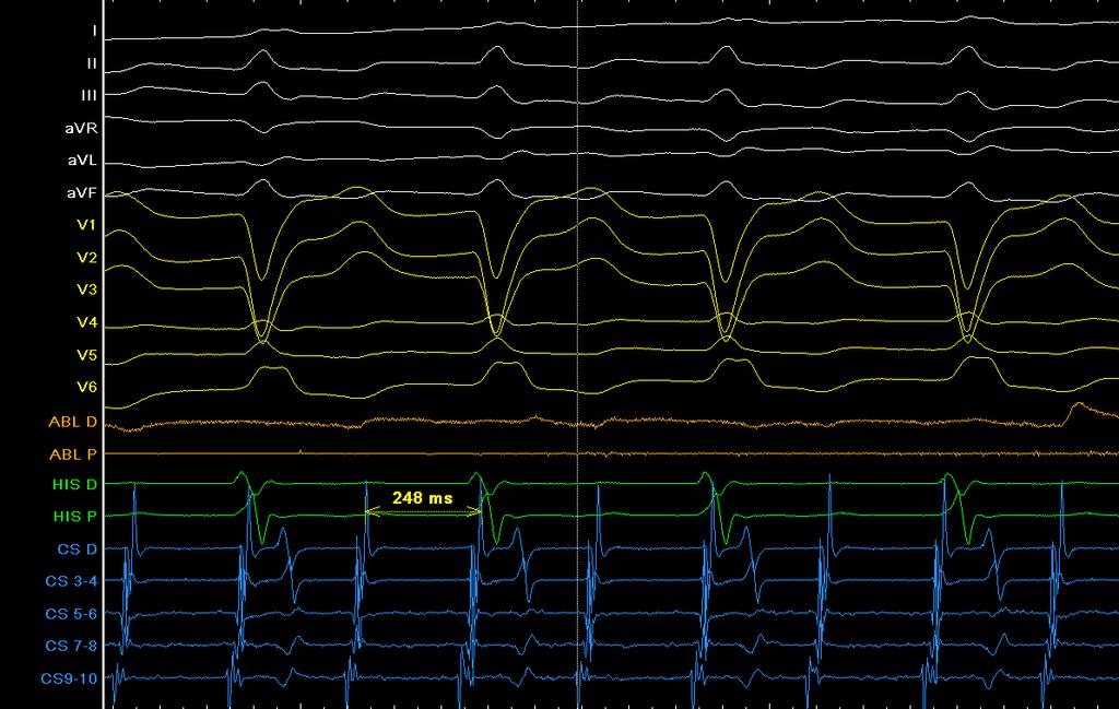 Organization to stable tachycardia with proximal to distal CS