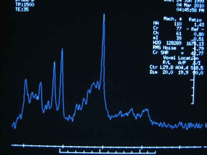 Kontrolna skupina zdravih otrok Bazalni gangliji TE 35 ms Bela možganovina TE 35 ms N- acetil aspartat/cr 1,43 Mioinozitol/Cr 0,51 N- acetil aspartat/cr 2,07 Mioinozitol/Cr 0,70 Starost, v letih